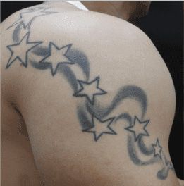 Fjerning av tatovering Før