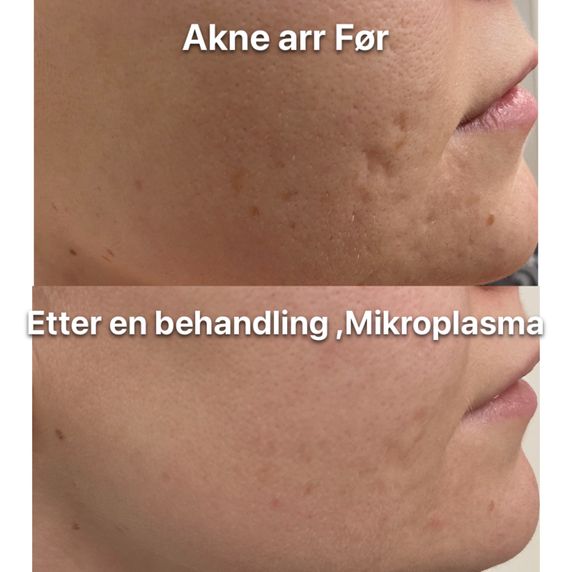 Akne arr behandling Oslo