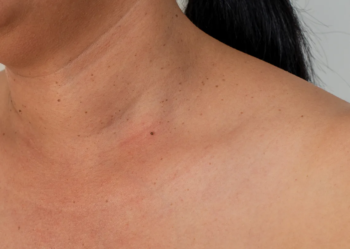 skin tag